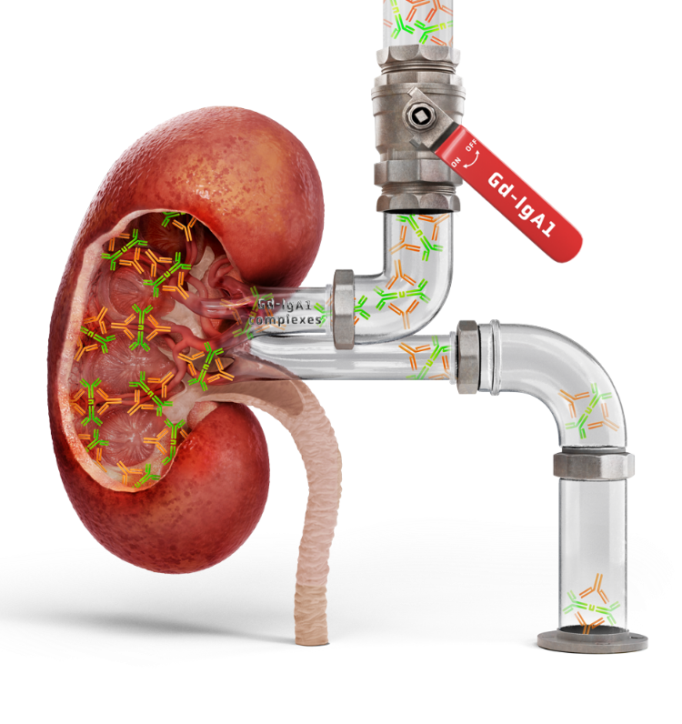 Cross-section of a kidney connected to clear pipes showing flow of Gd-IgA1 and immune complexes, illustrating IgAN disease mechanism.