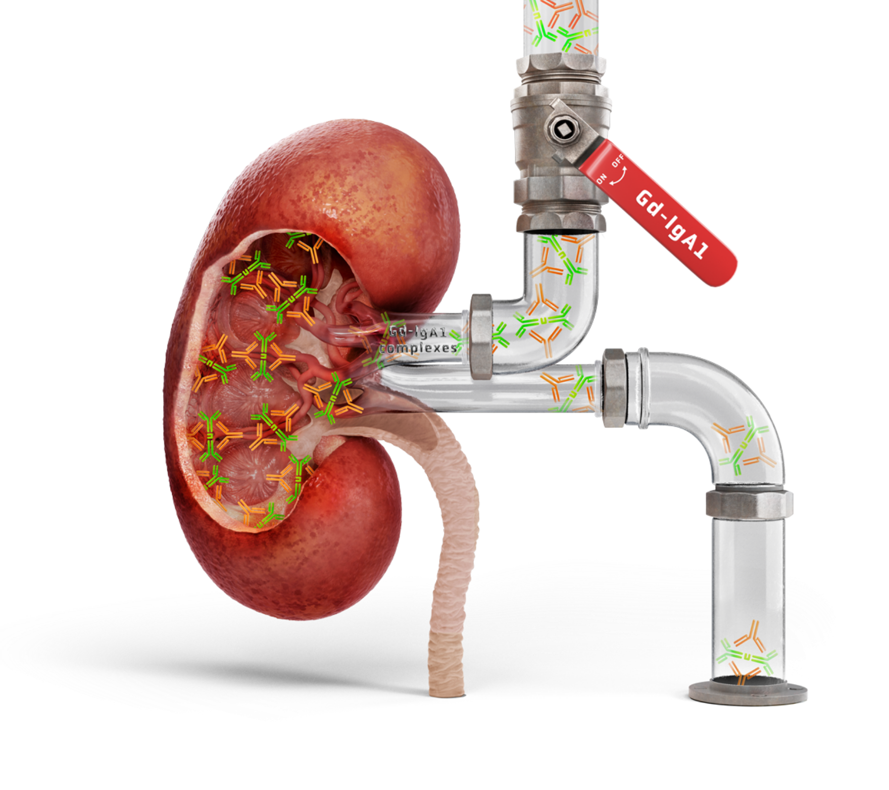 Cross-section of a kidney connected to clear pipes showing flow of Gd-IgA1 and immune complexes, illustrating IgAN disease mechanism.